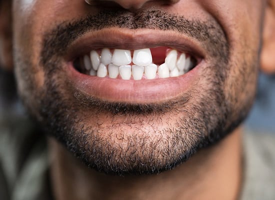 man with a missing front tooth