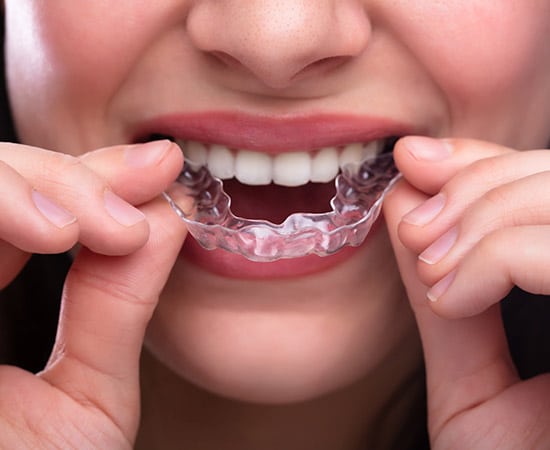 Invisalign tray being placed into mouth
