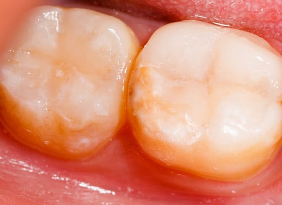 dental sealants example