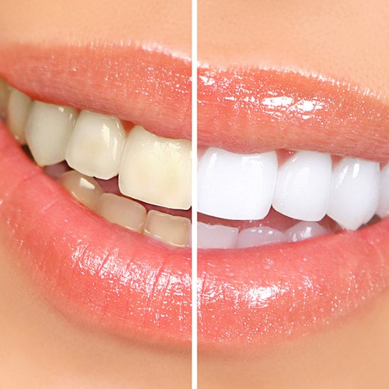 before and after of whitening