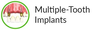 hybridge-multiple-tooth-labeled