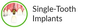hybridge-single-tooth-labeled