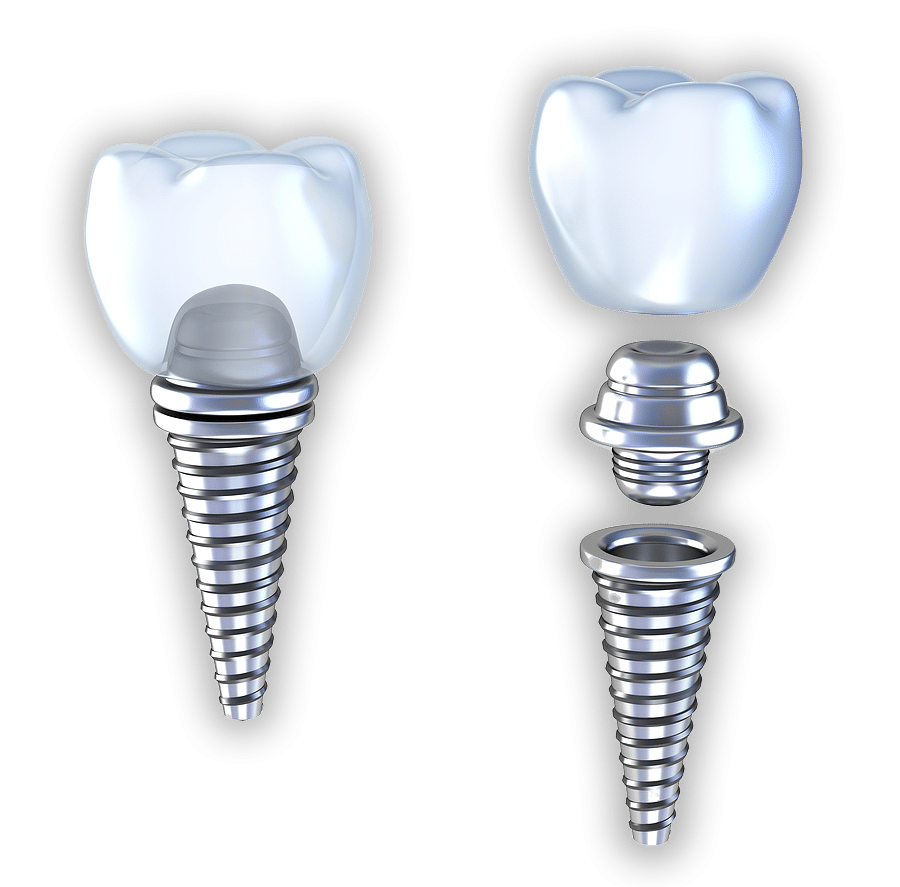 new-implant-section-model-v1