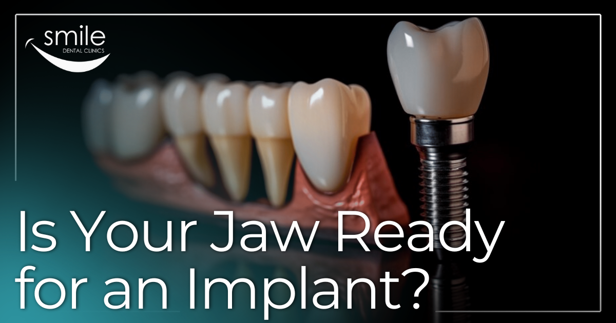 Is Your Jaw Ready for an Implant? dental implants